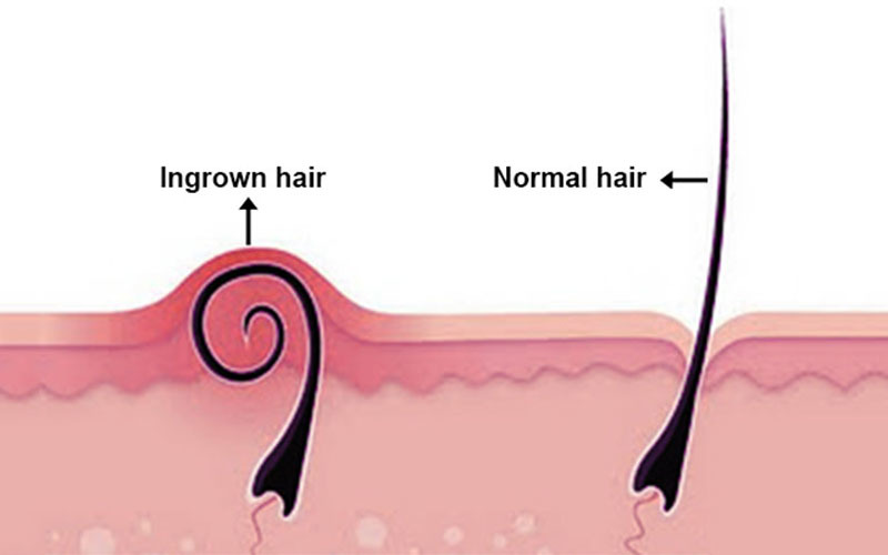 Treatment Options for Ingrown Hair and Herpes  Clinikally