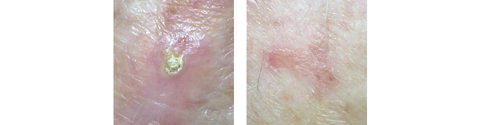 Is It Skin Cancer Or Just An Ingrown Hair Molemap Nz Official Site