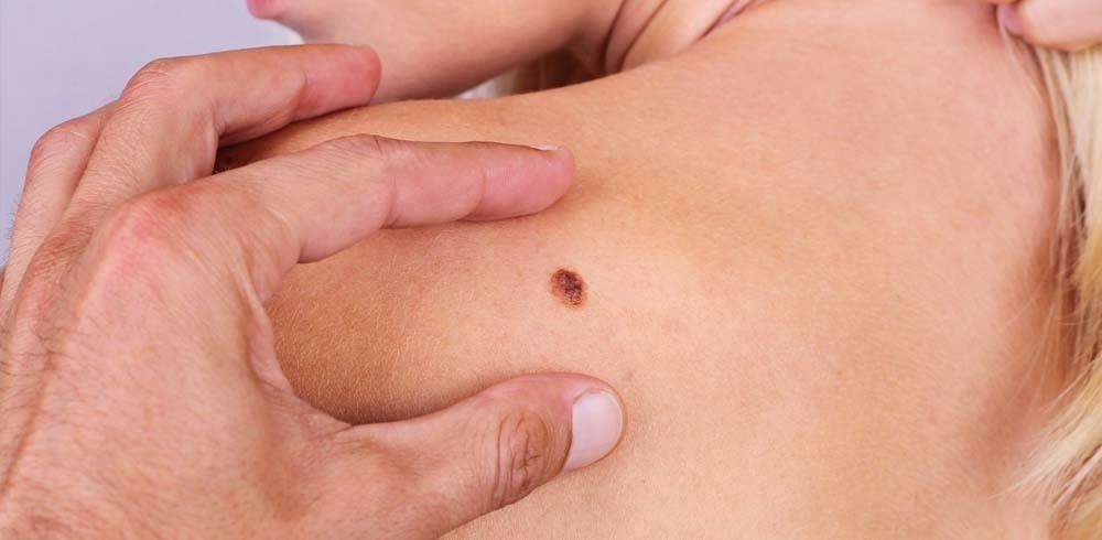 Skin Cancer Myths