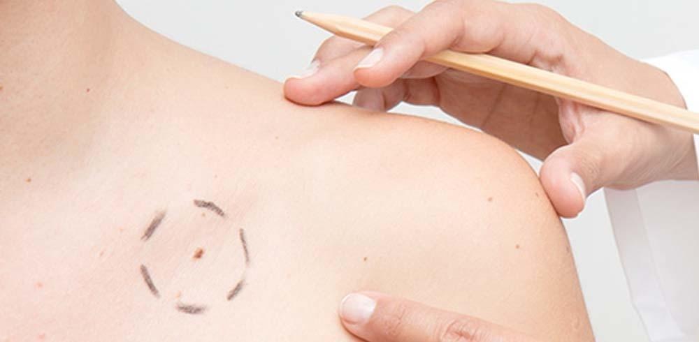 Skin Cancer Treatment