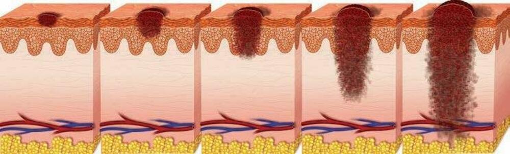 Understanding Early Melanoma Molemap Nz Official Site 