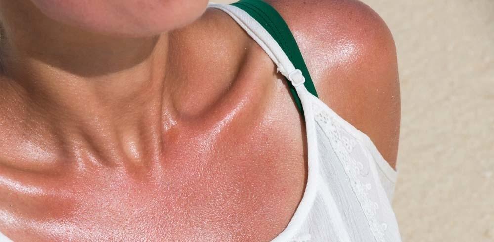 Sun Damage Can Cause Melanoma