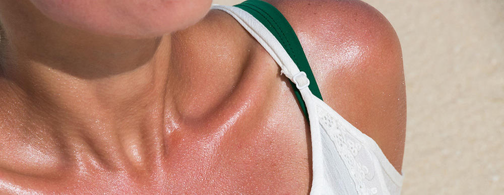 Sunburns Increase Your Skin Cancer Risk