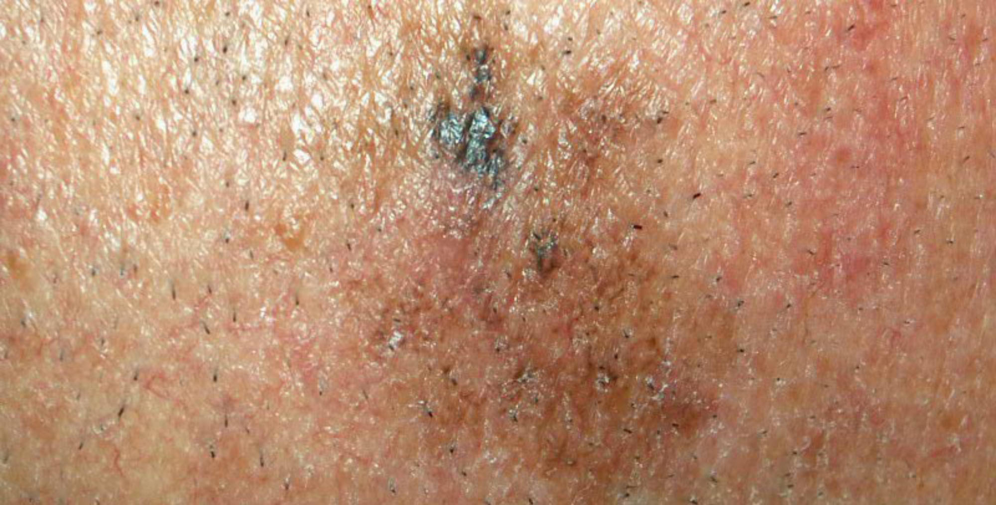 Sunspot or skin cancer how to spot the difference MoleMap NZ