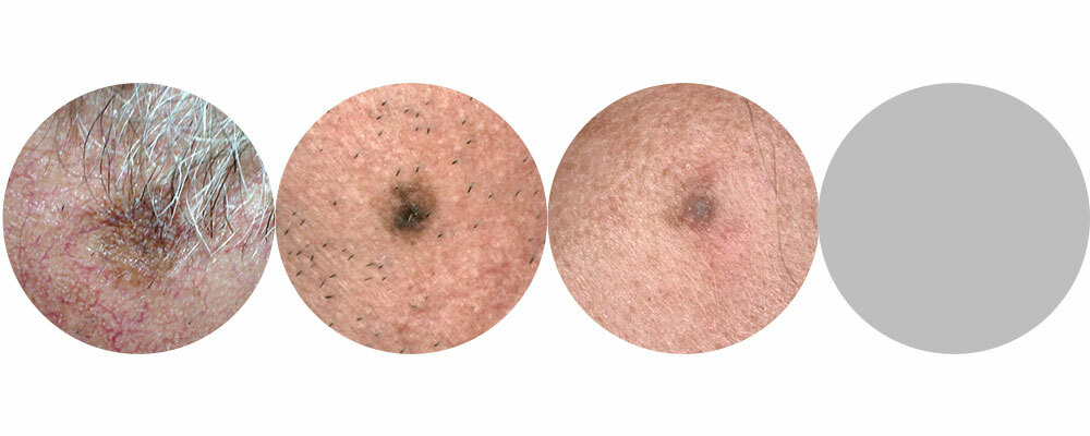 What does melanoma skin cancer look like? advice. | MoleMap Australia