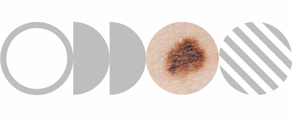Worried About Moles? Explore Our Mole guide to Spotting Skin Cancer