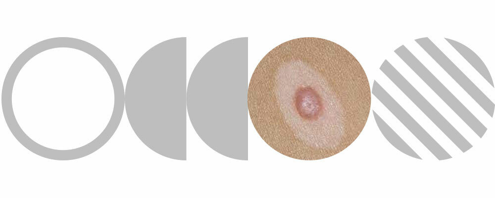 Worried About Moles? Explore Our Mole guide to Spotting Skin Cancer