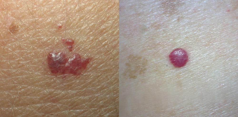 What does melanoma look like? - MoleMap