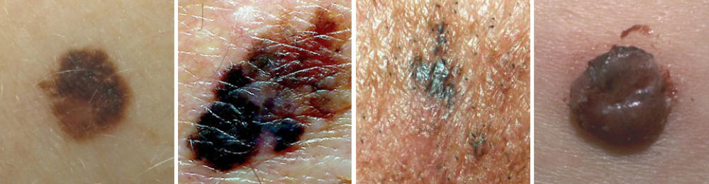 Types of skin cancer melanoma