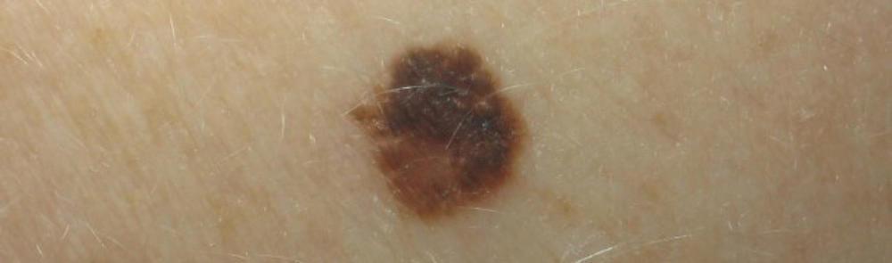 How To Identify The Signs Of Melanoma Molemap Nz Official Site