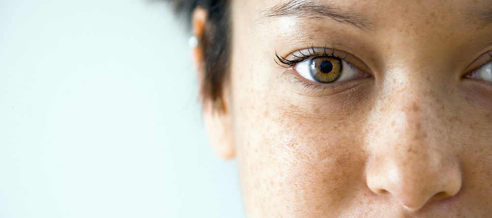 Freckles Moles And Sunspots What S The Difference Molemap Nz Official Site