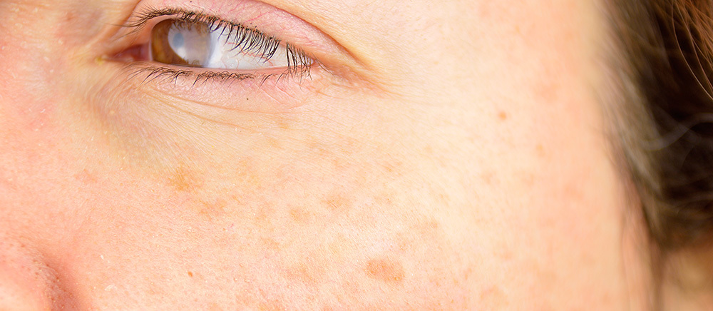 Freckles Moles And Sunspots What S The Difference Molemap Nz Official Site