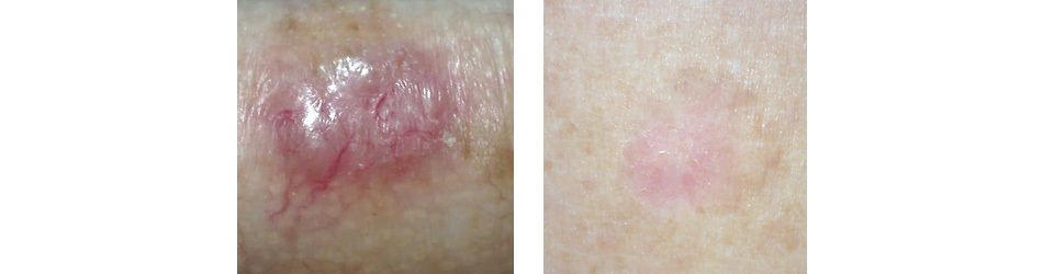 Is it skin cancer or just an ingrown hair? | MoleMap Australia