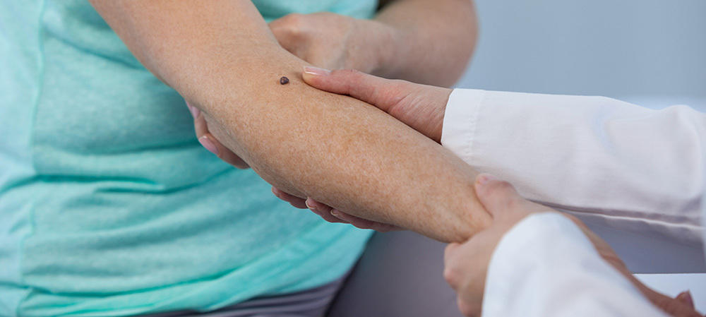 Early Stages Of Melanoma