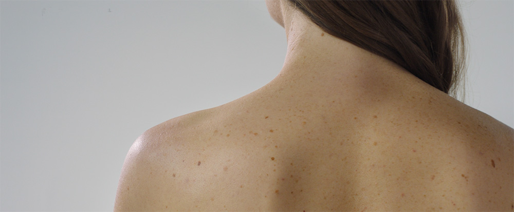 Melanoma Skin Cancer Changes To Your Skin