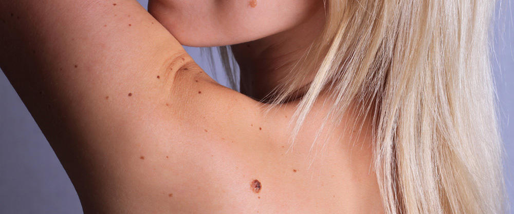 Moles Unusual Places