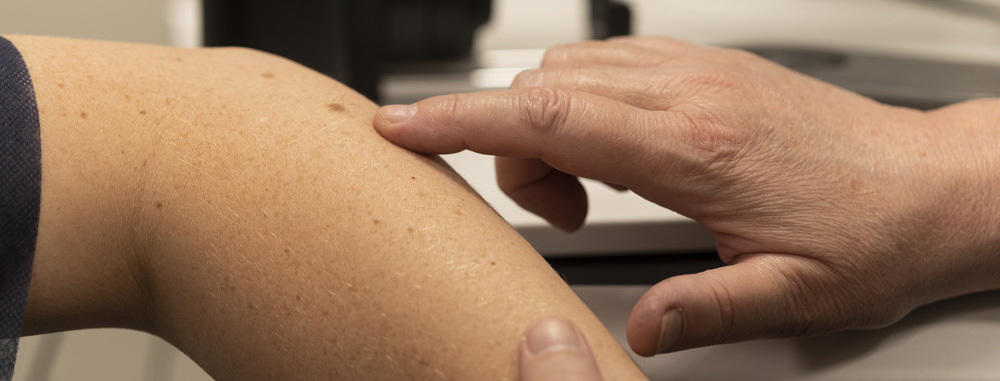 Early Signs Of Melanoma How To Identify Melanoma
