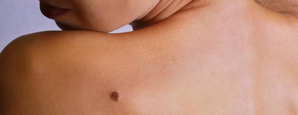 Melanoma Prevention Versus Detection Blog V1