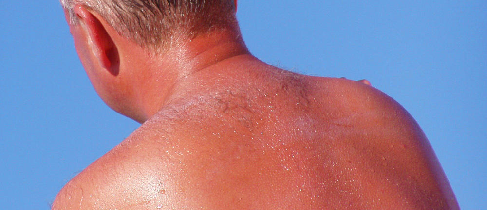 Skin Cancer Risk Factors