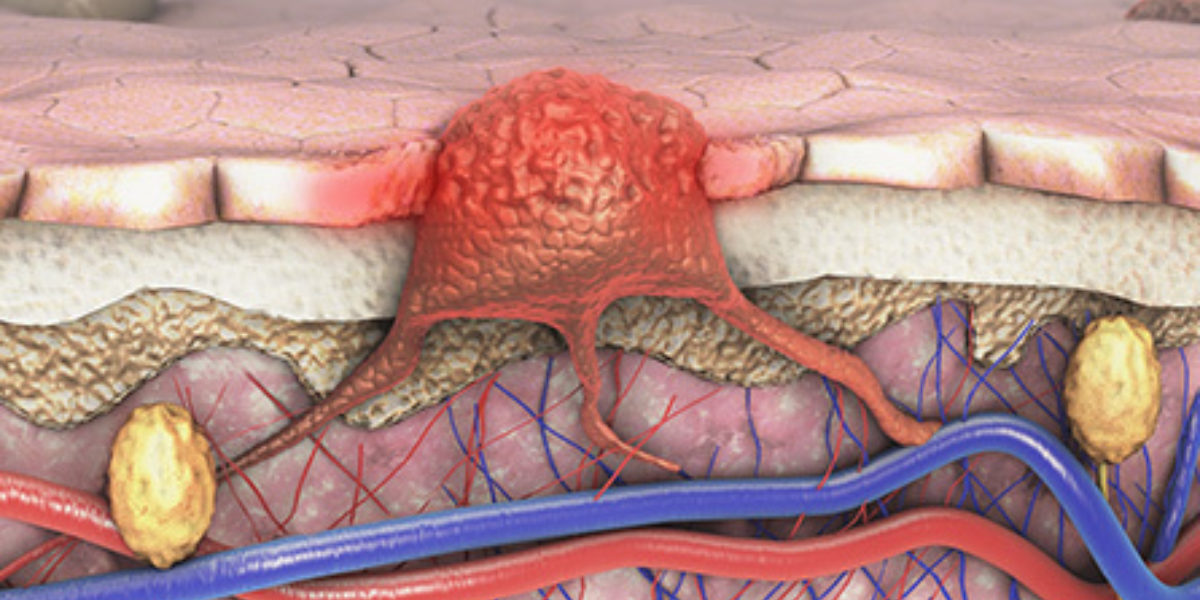 11 Skin Cancer Symptoms You Should Never Ignore Molemap
