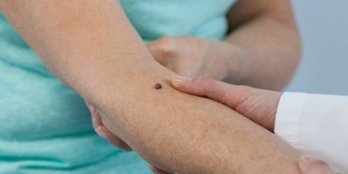 Is It A Sunspot Or Skin Cancer Molesafe