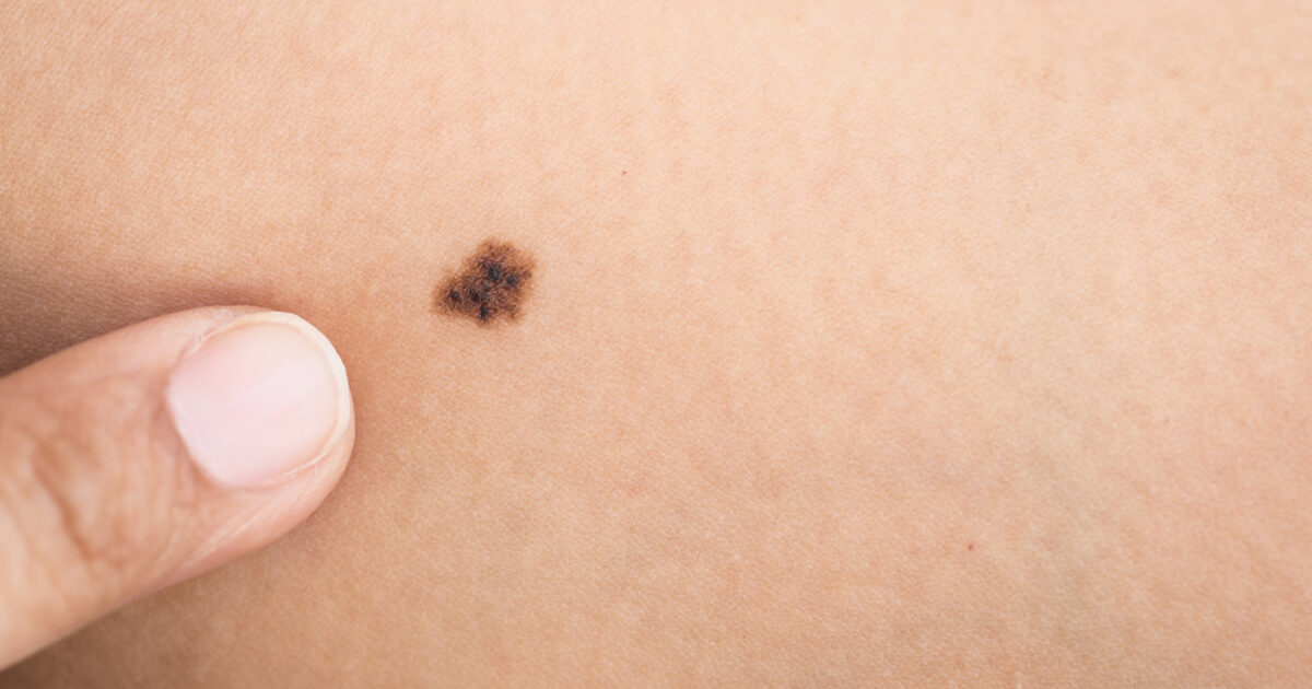 Signs and Symptoms of Skin Cancer 