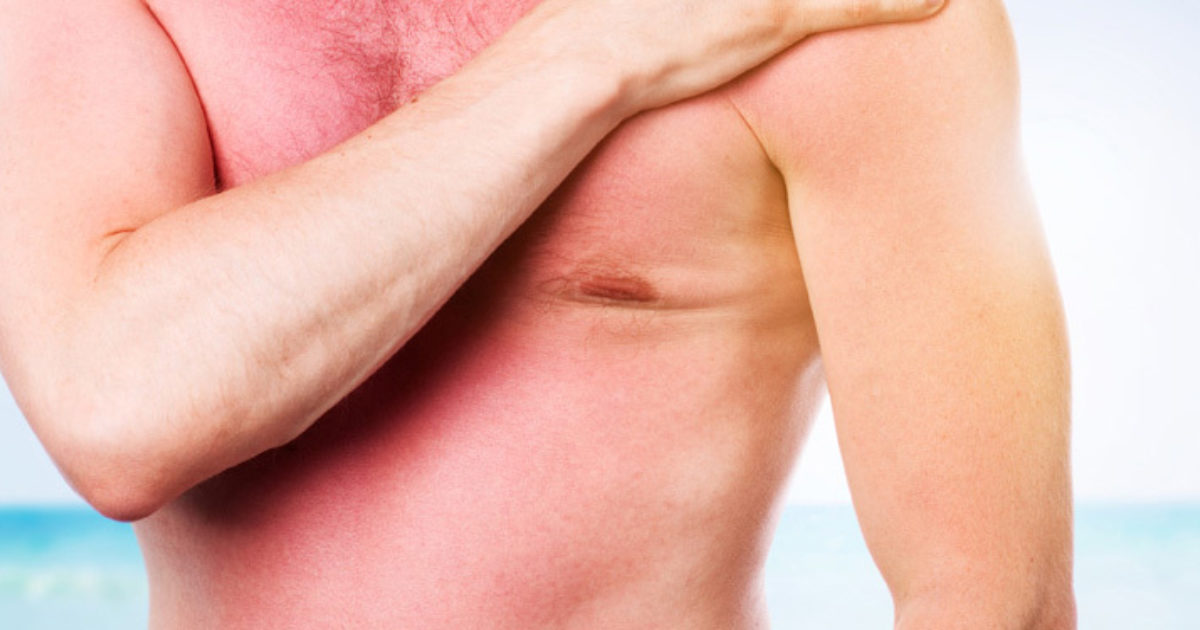 6 ways to treat and soothe sunburn MoleMap