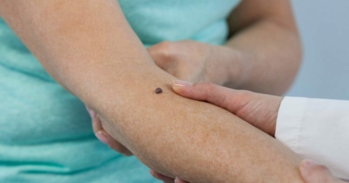 Is It A Sunspot Or Skin Cancer Molesafe Is It A Sunspot Or Skin Cancer Molesafe