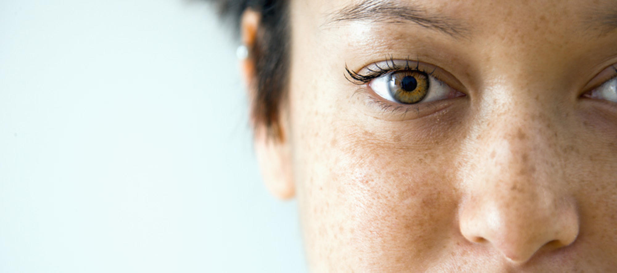 Freckles Moles And Sunspots What S The Difference Molemap Nz